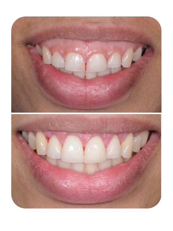 Resultado de correção de sorriso gengival — caso 1